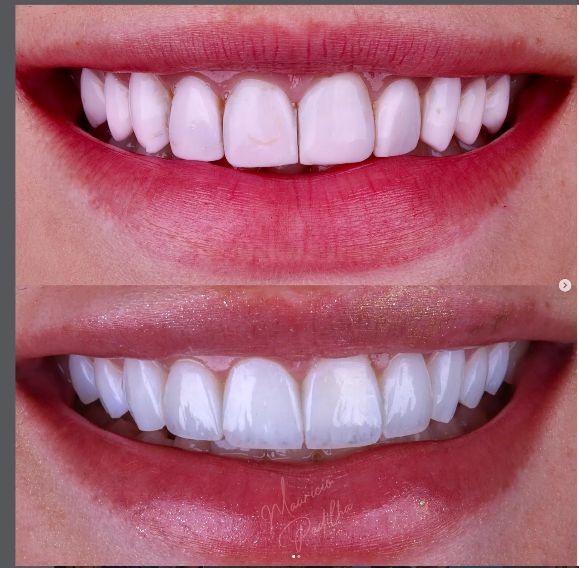 Caso de transformação do sorriso 1 com lentes em resina