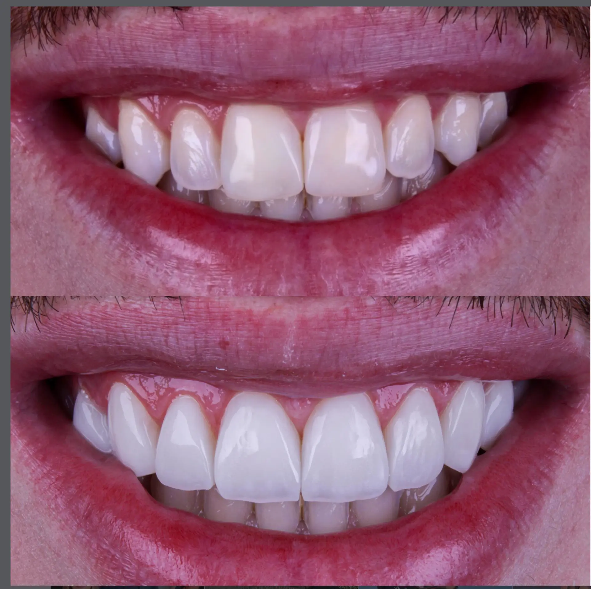 Antes e depois de reabilitação estética em sorriso masculino