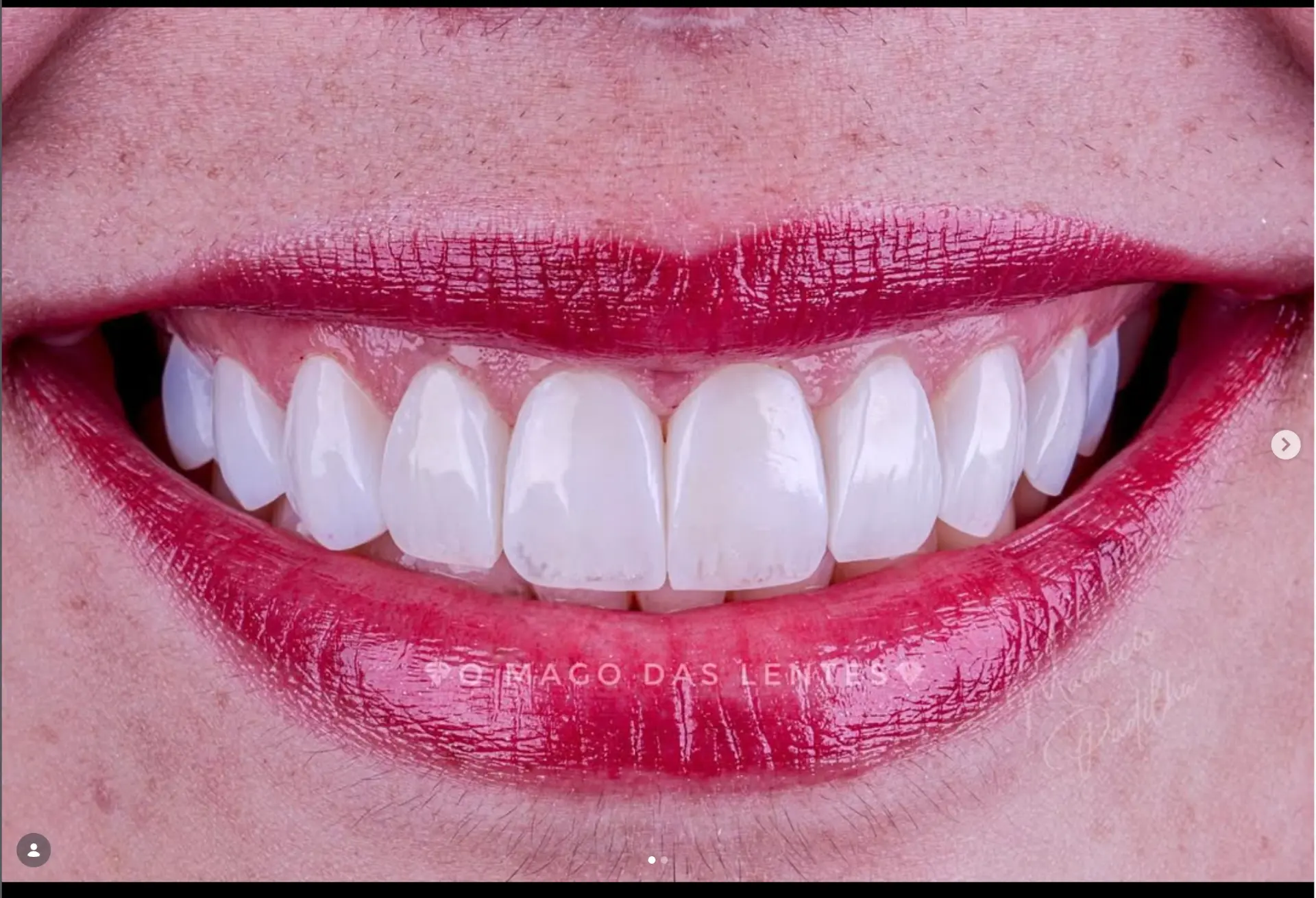 Caso de transformação do sorriso 3 com lentes em resina