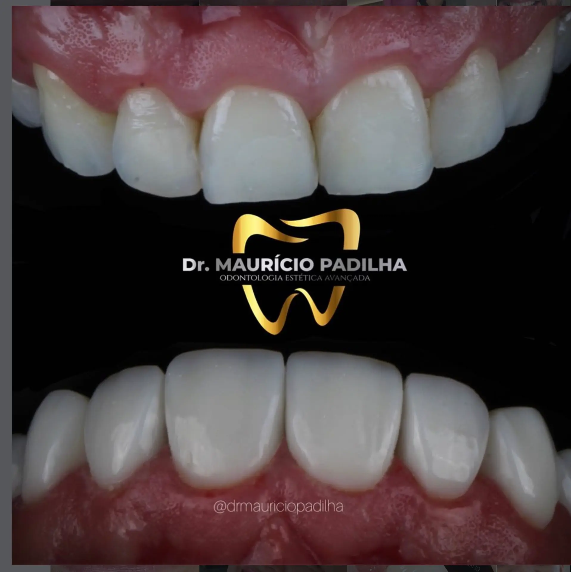 Detalhe do resultado de lentes em resina premium